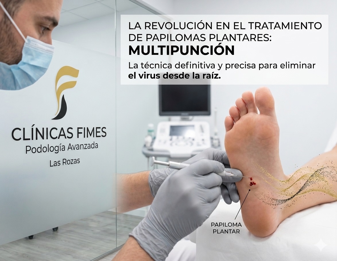 Papiloma en el pie: tratamiento con multipunción en Las Rozas